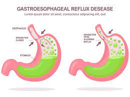 Was sind die Symptome von gastroösophagealem Reflux
